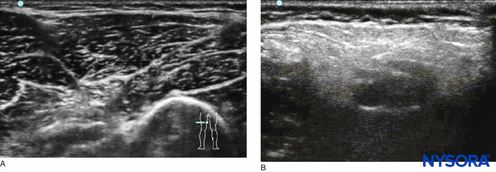 Comparison of US images of the popliteal fossae in (A) a healthy child and (B) a child with cerebral palsy.