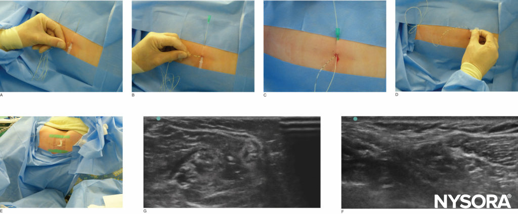 Tunneling of the popliteal catheter. The image in (F) illustrates an in-plane approach, whereas (G) illustrates an out-of-plane approach.