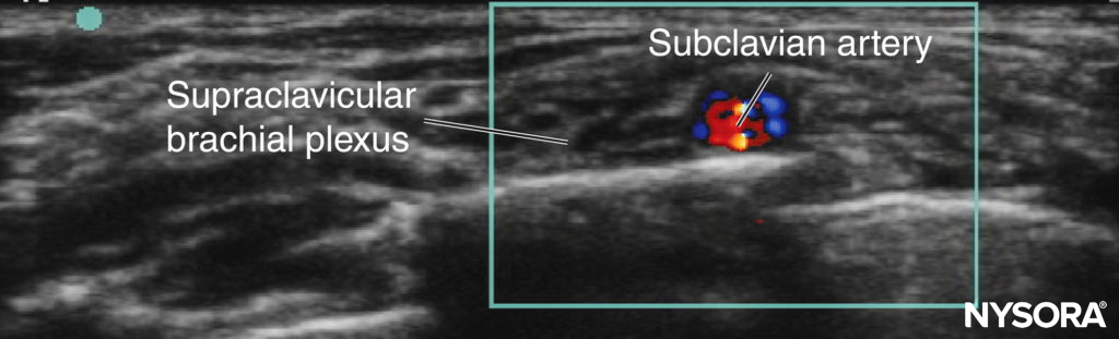 Supraclavicular block in a child: probe position and relevant sonoanatomy.
