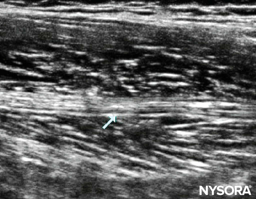 Longitudinal scan of the thigh highlighting the sciatic nerve in a 6-year-old.