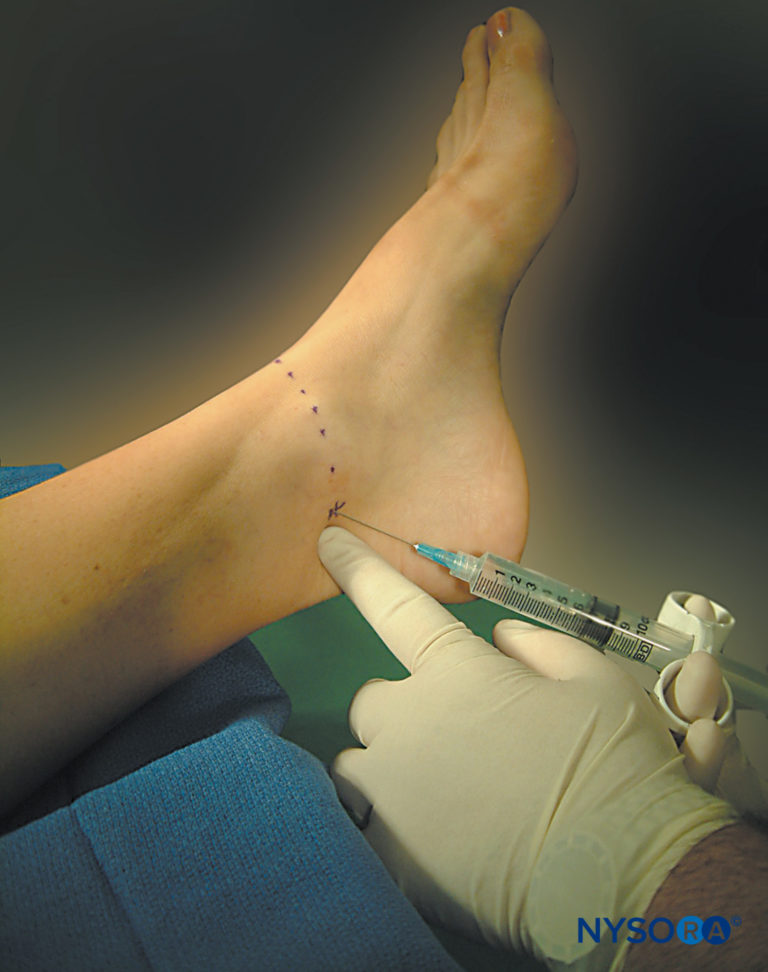 regionalanesthesiablockoftheposteriortibialnerve NYSORA NYSORA