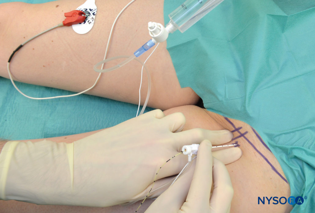 Femoral Nerve Block Landmarks and Nerve Stimulator Technique NYSORA