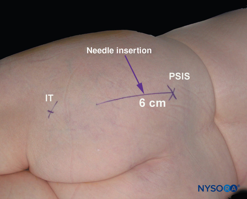 https://www.nysora.com/wp-content/uploads/2018/07/regional-anesthesia-parasacral-approach-sciatic-nb-superior-iliac-spine.jpg