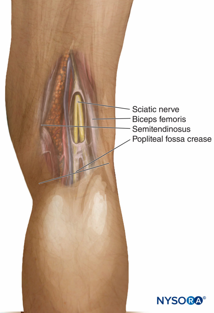 Popliteal block. Landmarks for the intertendinous approach.