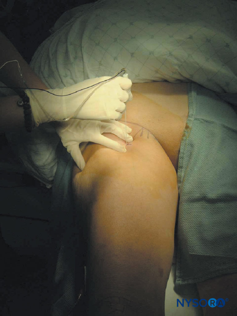 https://www.nysora.com/wp-content/uploads/2018/07/regional-anesthesia-sciatic-nb-through-anterior-approach-needle-insertion.jpg