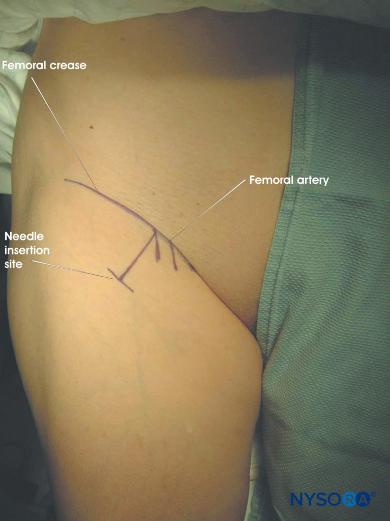 sciatic nerve block anterior approach