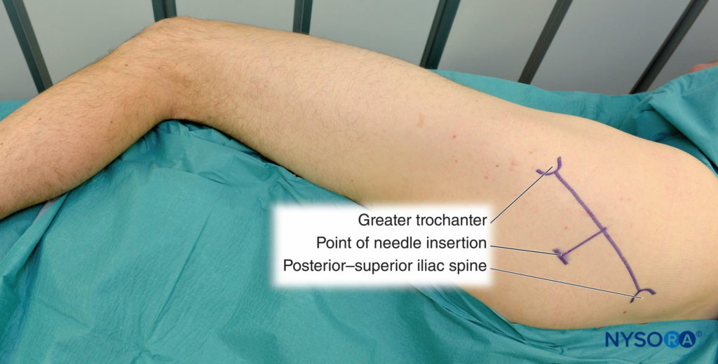 sciatic nerve block anterior approach