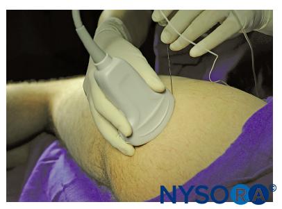 https://www.nysora.com/wp-content/uploads/2018/07/regional-anesthesia-transgluteal-approach-to-sciatic-block.jpg