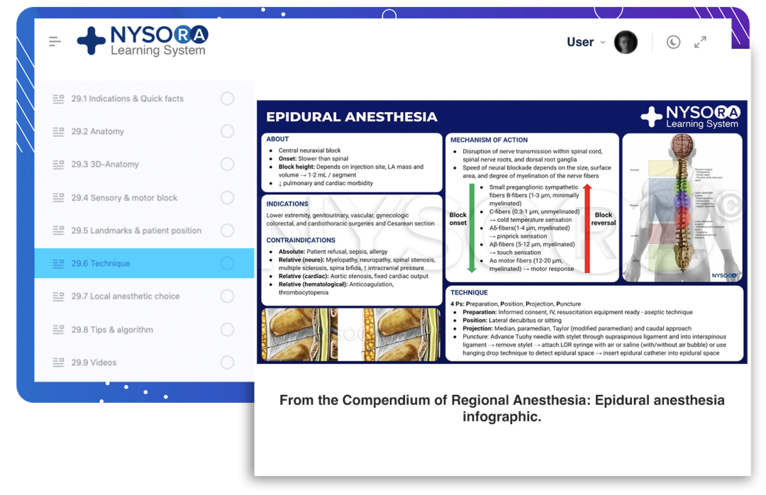 11. Epidural Anesthesia and Analgesia NYSORA NYSORA