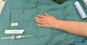 Equipment for IVRA consists of Esmarch bandage, local anesthetic vials, rubber tourniquet, intravenous (IV) extracatheter (catheter over needle), alcohol swabs, and a syringe to draw up local anesthetic.