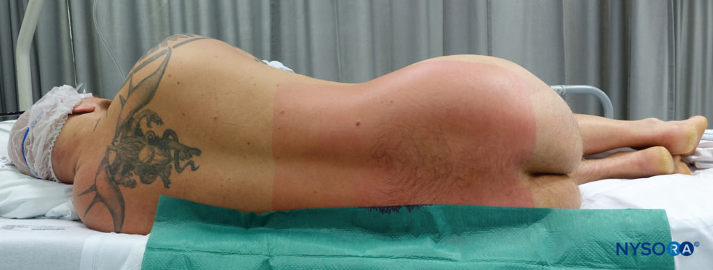 Epidural placement in the lateral position