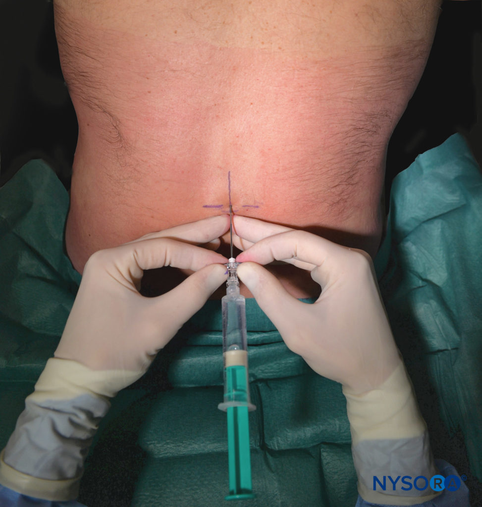 Advancing epidural needle: thumbs and index fingers grasping wings.