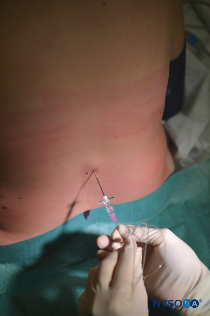 Inserting the epidural catheter