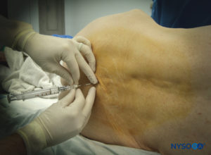 Paramedian epidural technique.