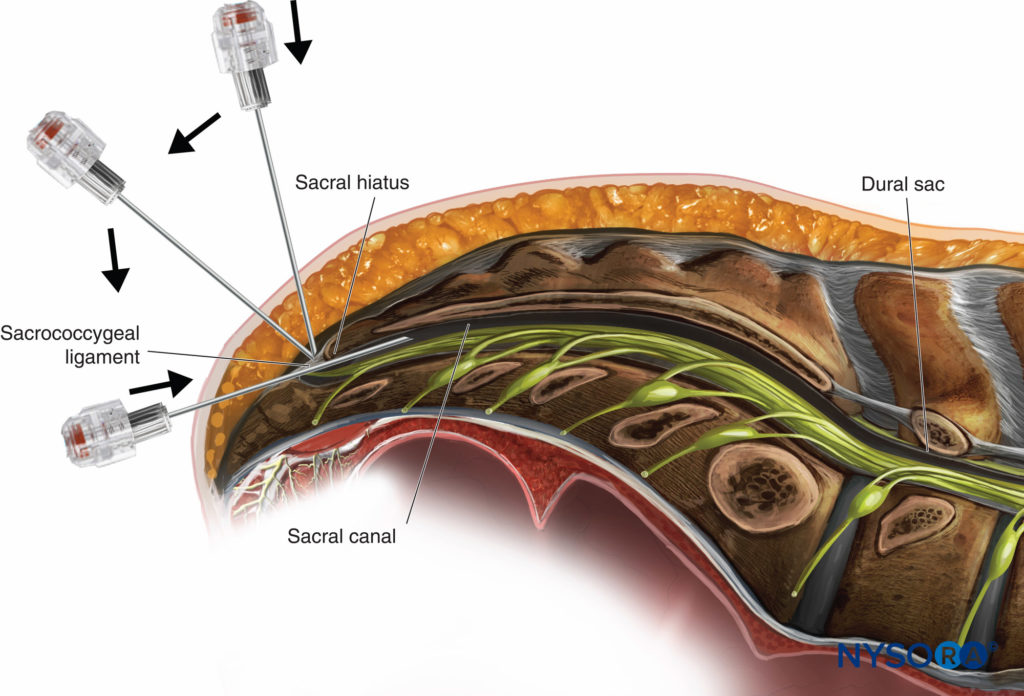 Epidural Anesthesia and Analgesia - NYSORA