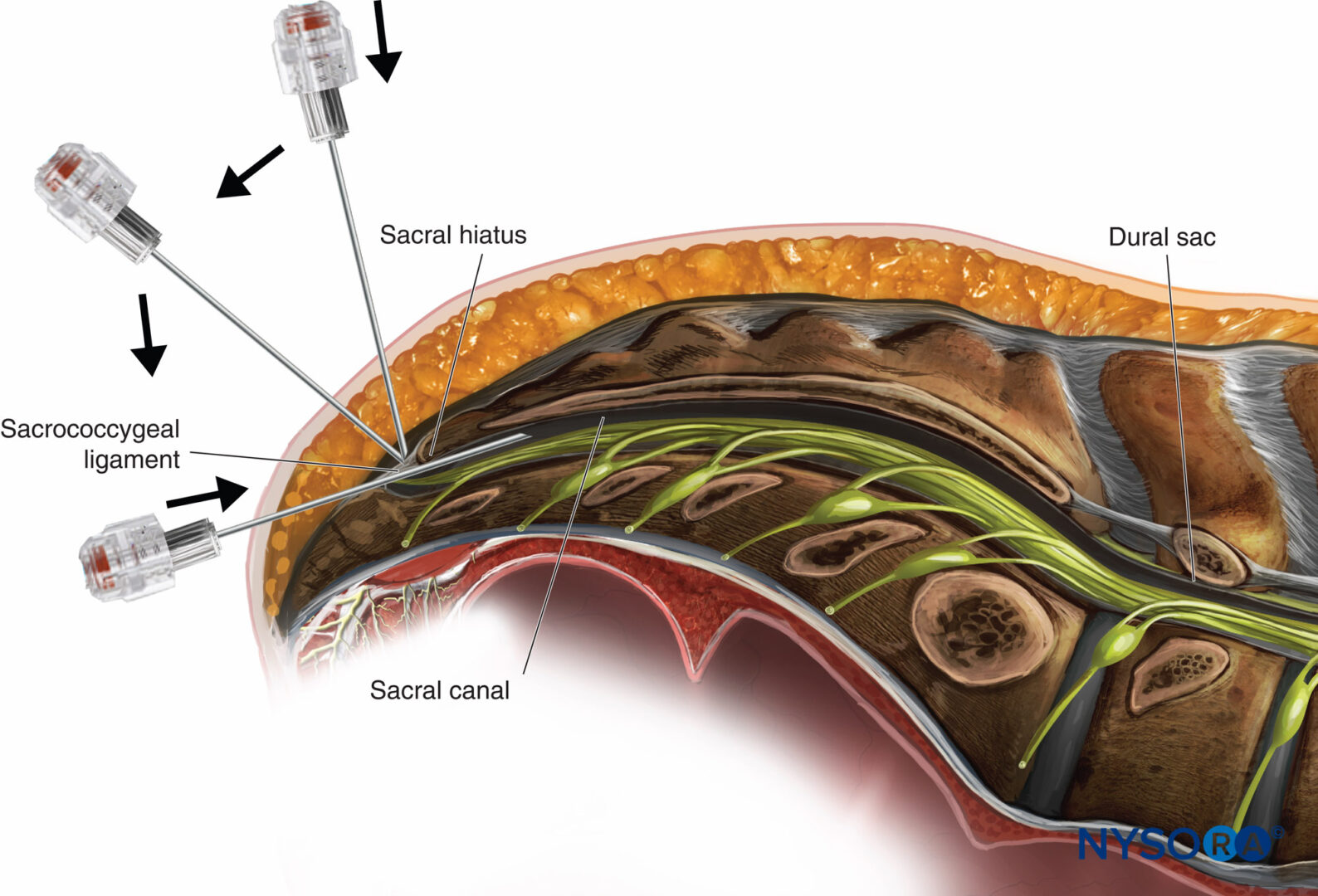 bloqueo epidural lumbar l5 s1 bloqueo epidural lumbar l5 s1