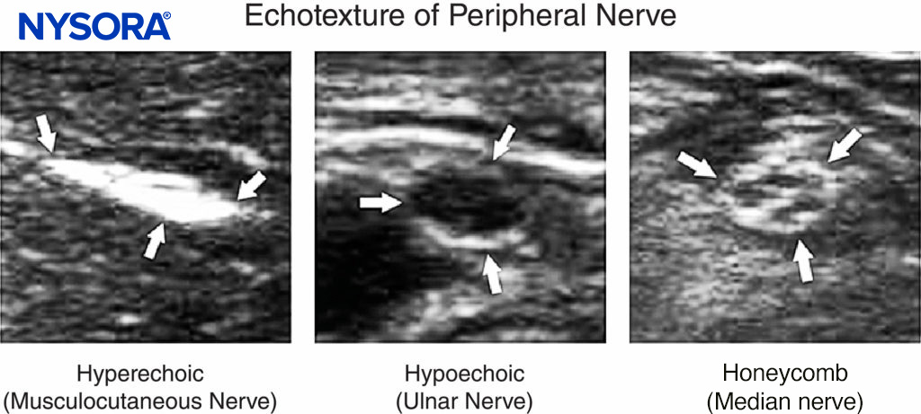 Echotexture of peripheral nerves. (Reproduced with permission from Hadzic A: Hadzic’s Peripheral Nerve Blocks and Anatomy for Ultrasound-Guided Regional Anesthesia, 2nd ed. New York: McGraw-Hill, Inc.; 2011.)