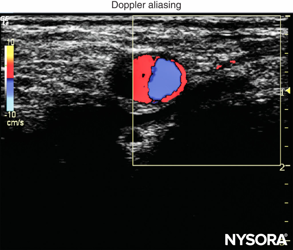 Color Doppler aliasing occurs when the velocity scale for color Doppler is set too low.