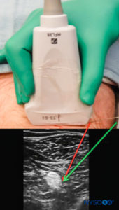 anesthesia nysora