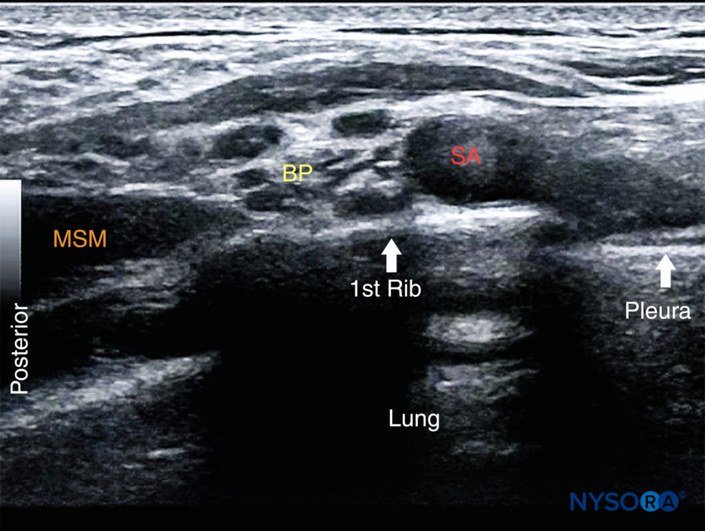 View of the brachial plexus (BP) at the supraclavicular fossa. When identification of the brachial plexus at the interscalene level proves difficult, the transducer is positioned at the supraclavicular fossa to identify the BP superficial and posterior to the subclavian artery (SA). The transducer is then slowly moved cephalad while continuously visualizing the brachial plexus until the desired level is reached.