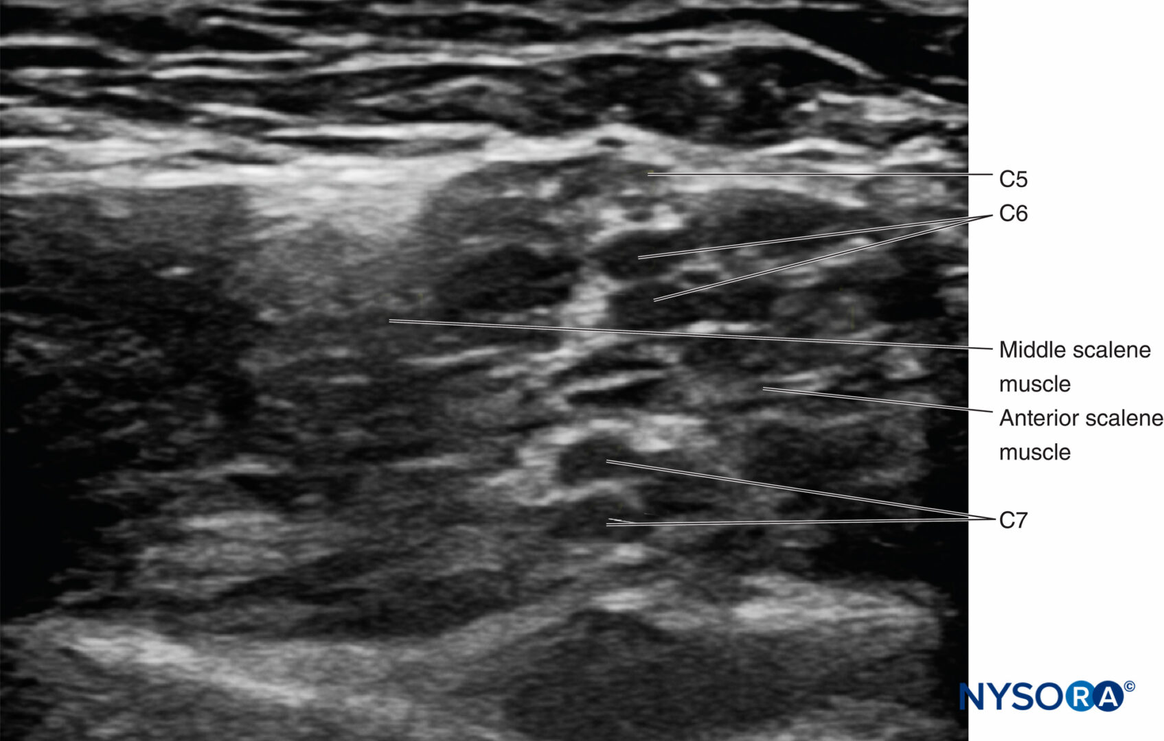 UltrasoundGuided Interscalene Brachial Plexus Nerve Block NYSORA