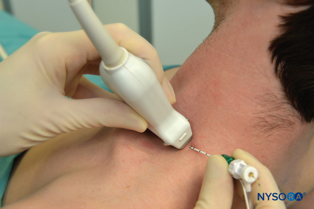 Continuous brachial plexus block. The needle is inserted in the interscalene space using an in-plane approach. Note that for didactic purposes, neither sterile drapes nor ultrasound transducer cover are used in this figure.