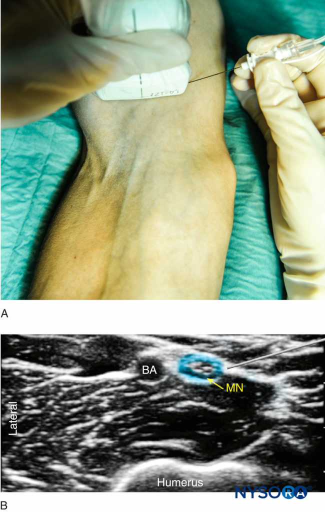 (A)Position of the arm, probe and needle for median nerve block proximal to the elbow.(B)Distribution of local anesthetic (blue-shaded area) for MN block. BA, brachial artery.