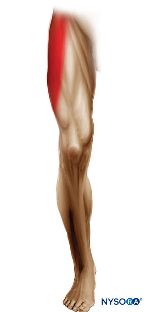Expected distribution of lateral femorocutaneous nerve sensory block.