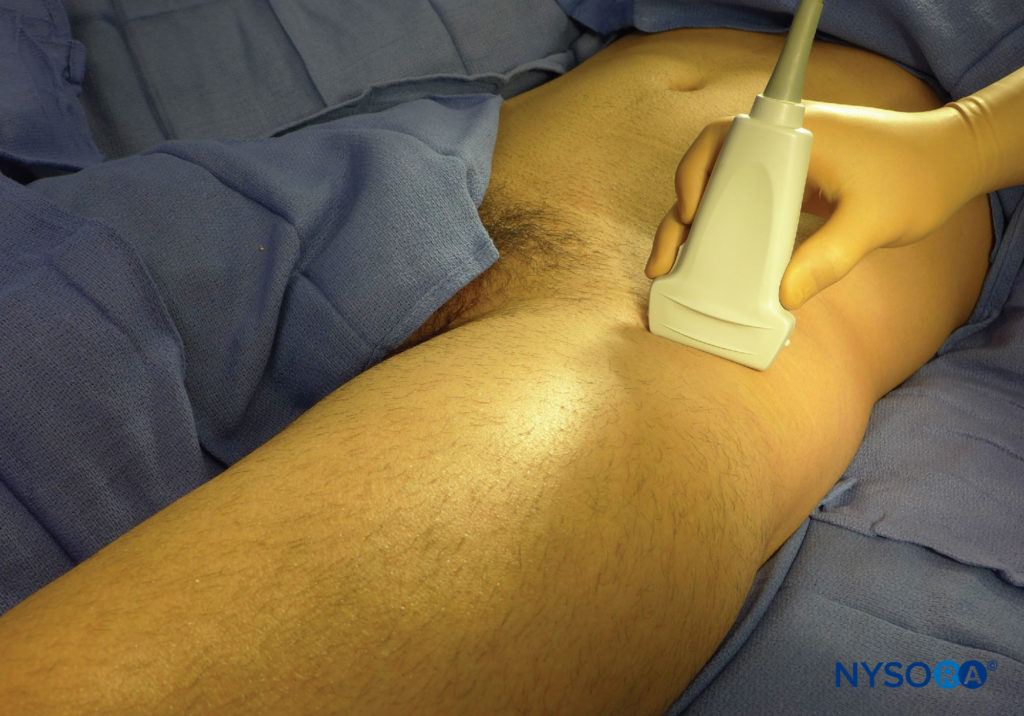 Transducer position to accomplish a lateral femoral cutaneous nerve (LFCN) block.