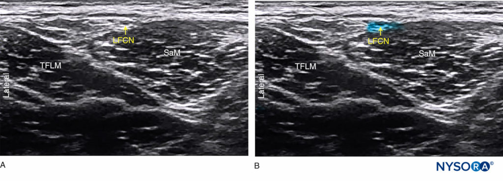 (A) Ultrasound anatomy of the lateral femoral cutaneous nerve (LCFN). (B) Simulated needle path and local anesthetic spread (blue-shaded area) to anesthetize the LFCN.