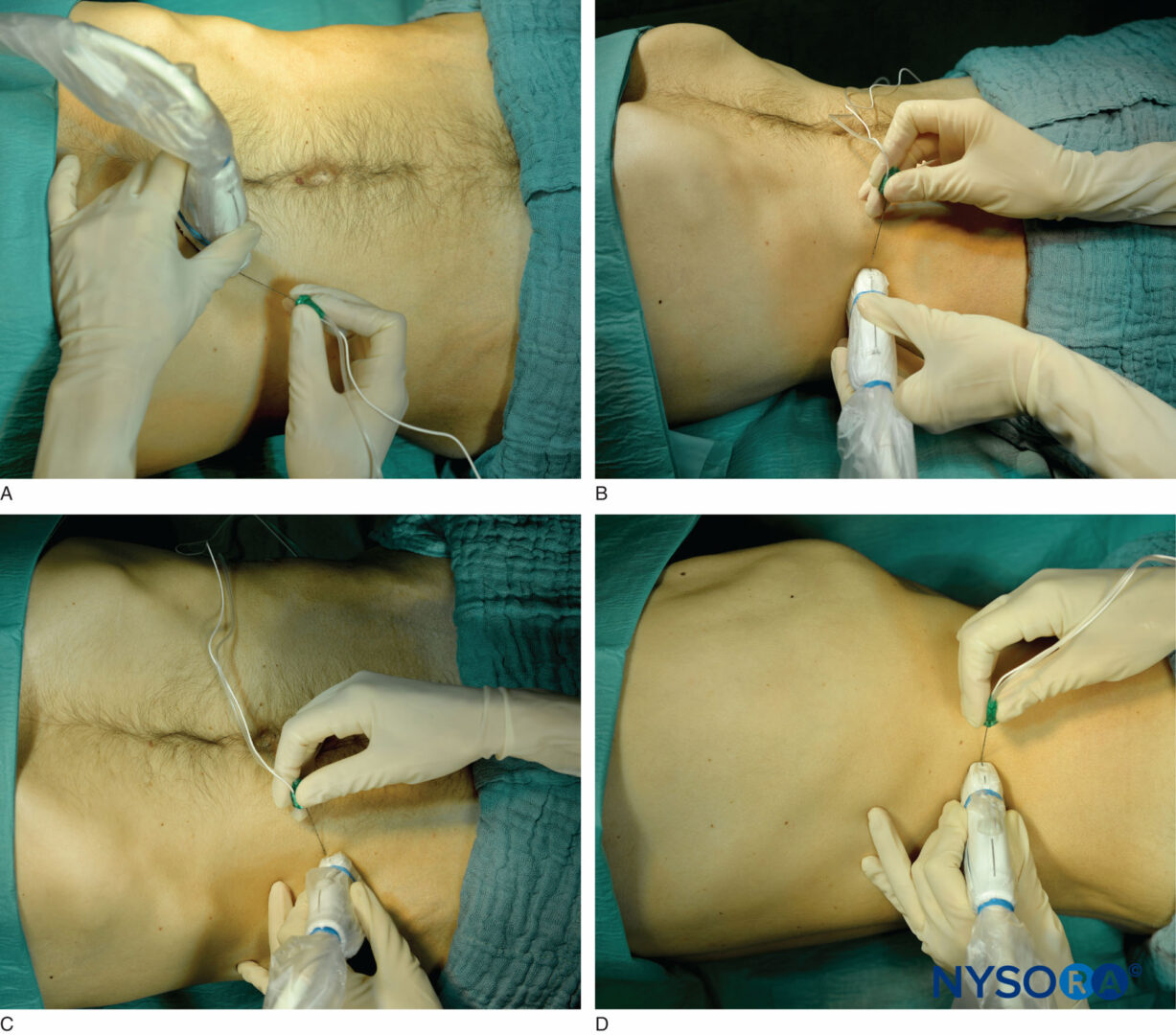 quadratus lumborum