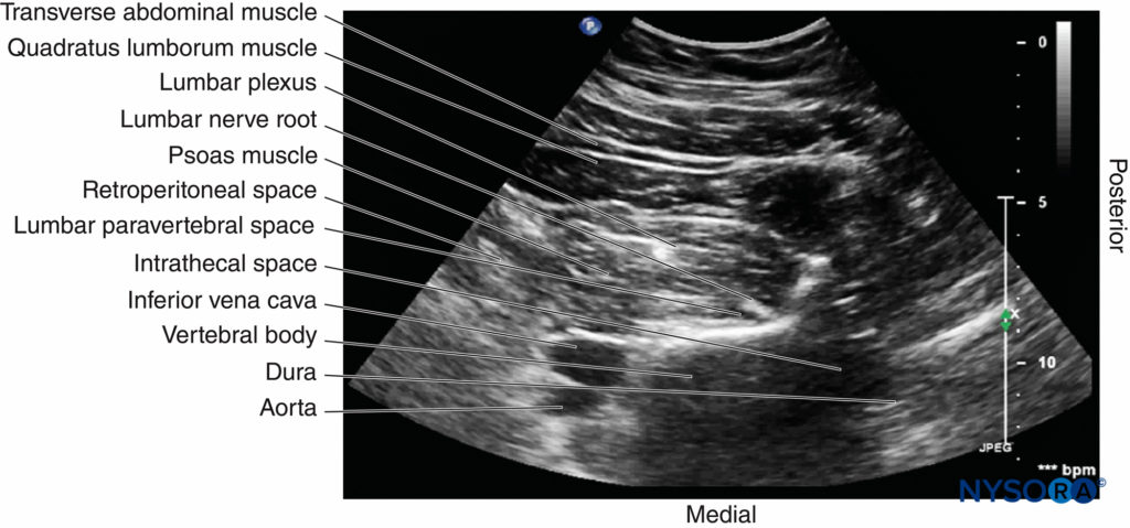 Transverse sonogram of the lumbar paravertebral region during the Shamrock method, with the US beam insonated at the level of the transverse process.