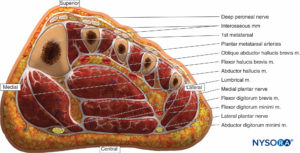 Acute Compartment Syndrome of the Limb: Implications for Regional