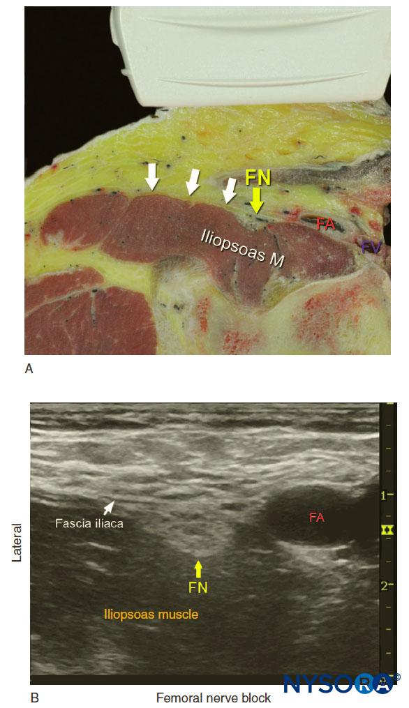 Ultrasound Guided Femoral Nerve Block Nysora