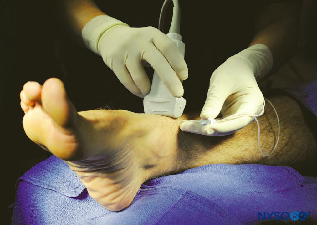 Ultrasound-Guided Ankle Block