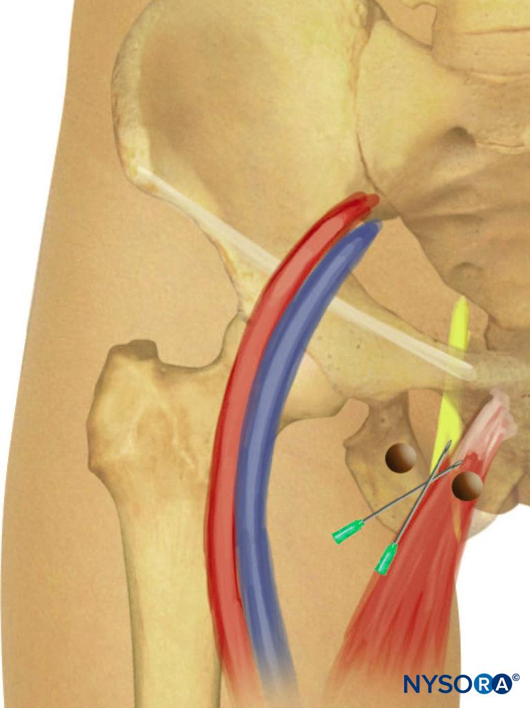 Paravascular selective inguinal approach to medial aspect of the knee.Needle insertion and redirection.
