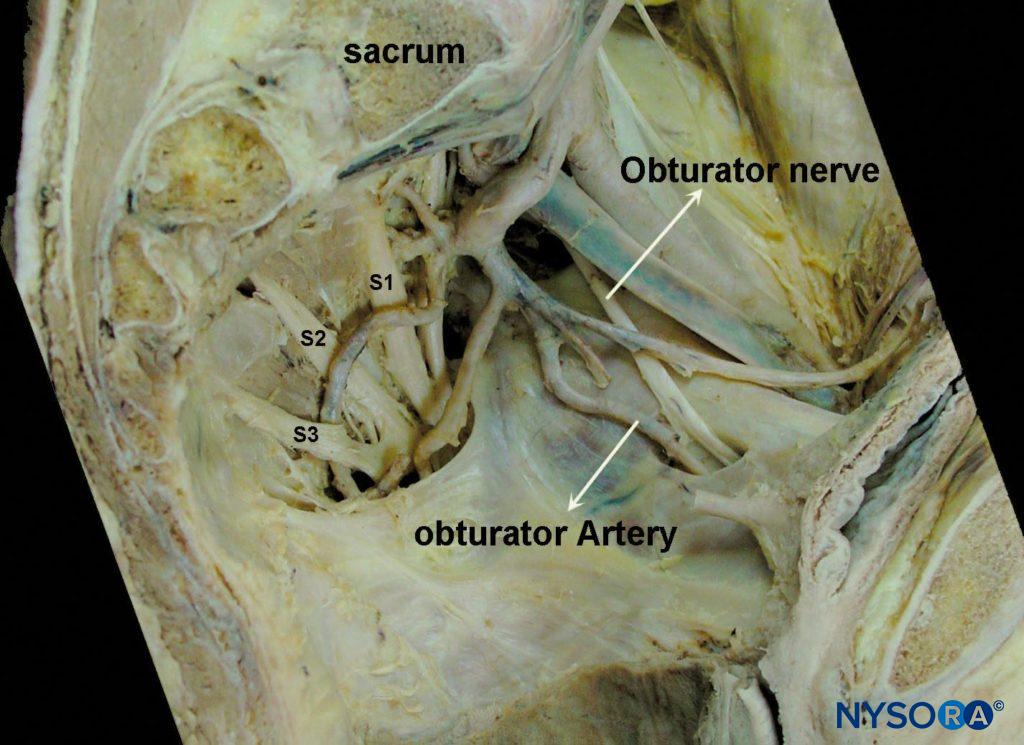 Intrapelvic trajectory of the obturator nerve. After crossing under the iliac vessels, the obturator nerve travels toward the obturator foramen via the lateral pelvic wall. During this course, the obturator artery and vein join the nerve, forming the obturator neurovascular bundle.