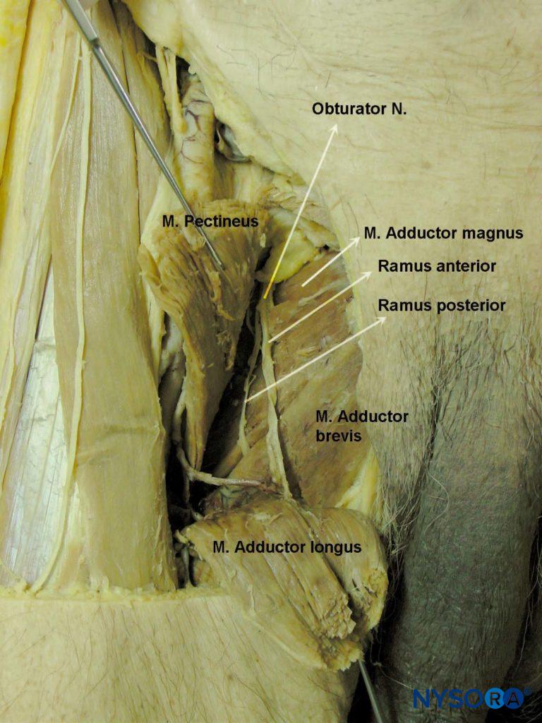 Distribution of the anterior and posterior divisions of the obturator nerve after exiting the obturator foramen.