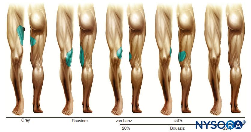 Skin innervation by obturator nerve according to different investigators.