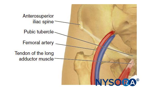 Anatomic landmarks for blockade of the obturator nerve.