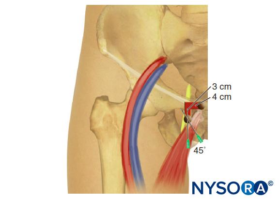 Obturator nerve block. Simplified Labat classic technique.