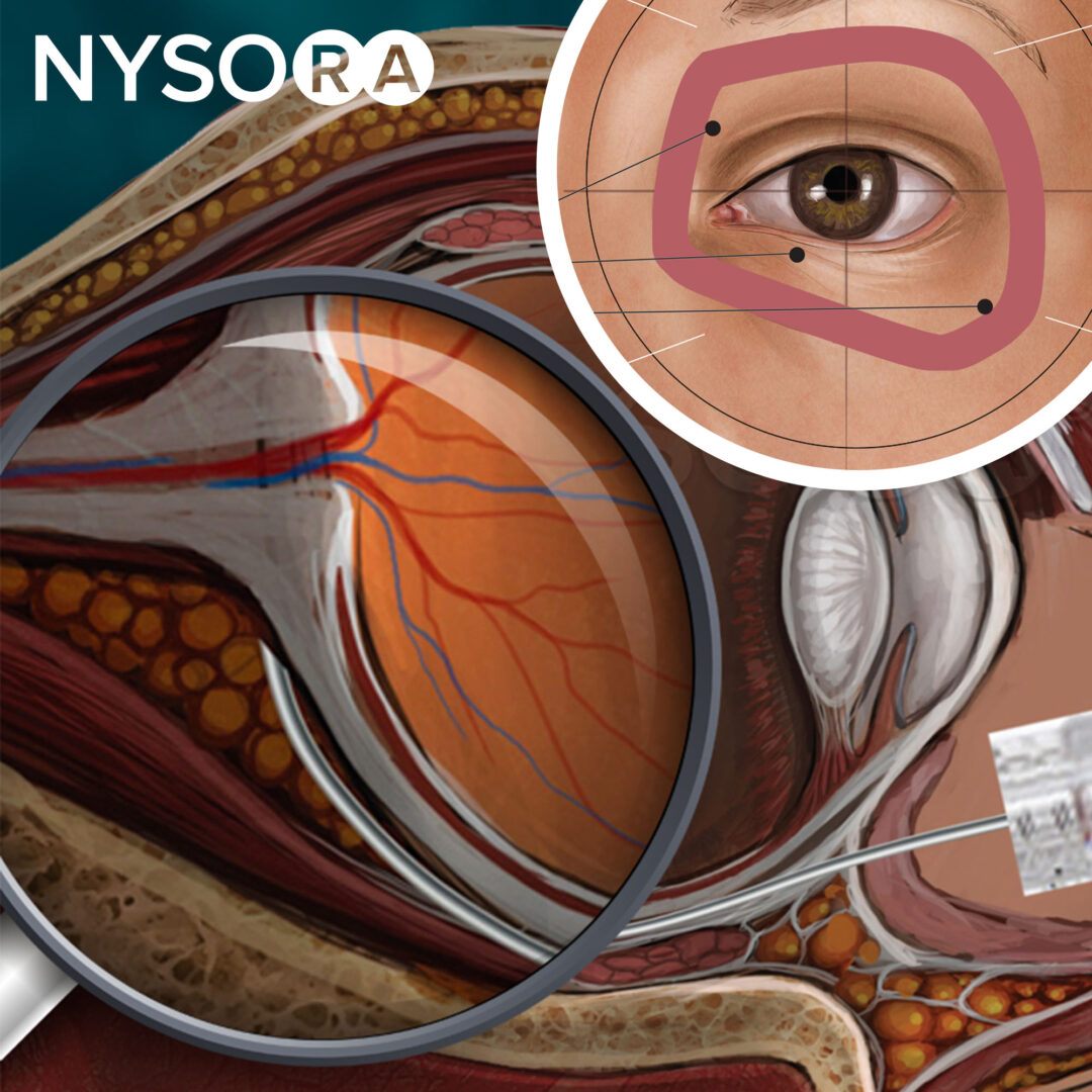 眼科手術のための局所および局所麻酔-NYSORA| NYSORA
