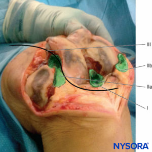 Four steps LIA injection technique in patients having knee replacement.