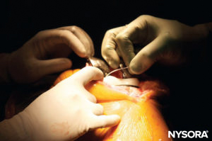 The catheter is placed into the knee laterally.