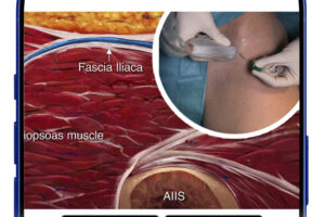 Fascia Iliaca Illustration