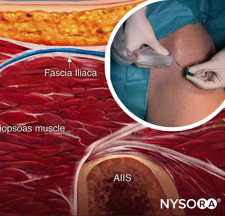 Ultrasound-Guided Fascia Iliaca Nerve Block - NYSORA