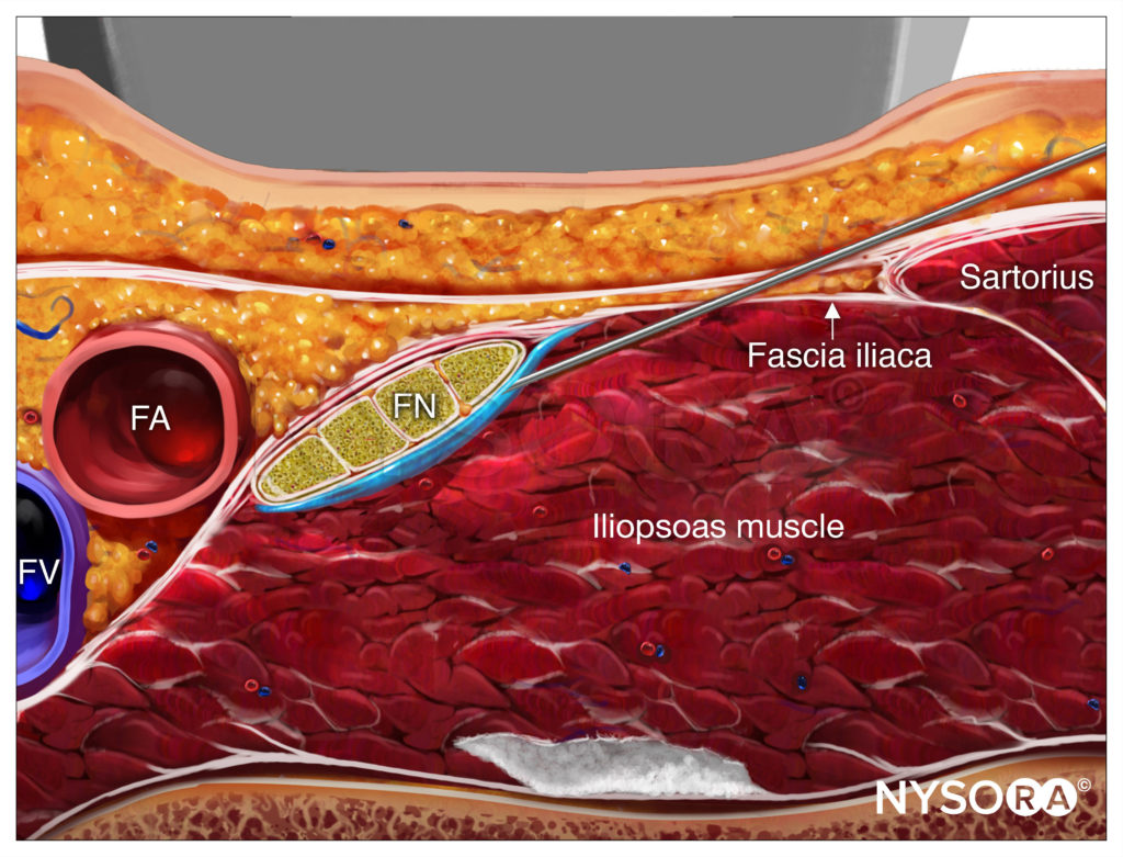 UltrasoundGuided Femoral Nerve Block NYSORA