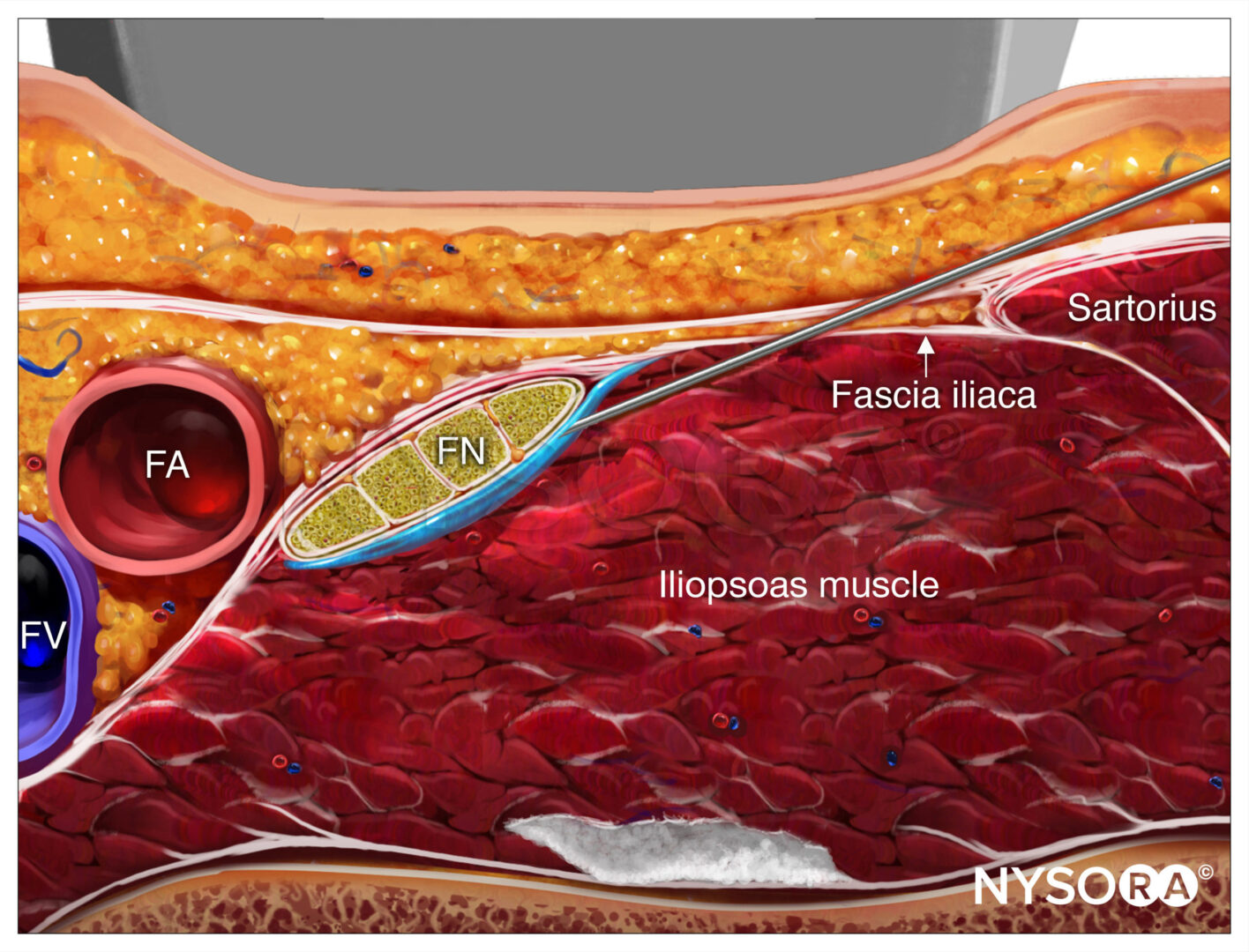 Ultrasound-Guided Femoral Nerve Block - NYSORA