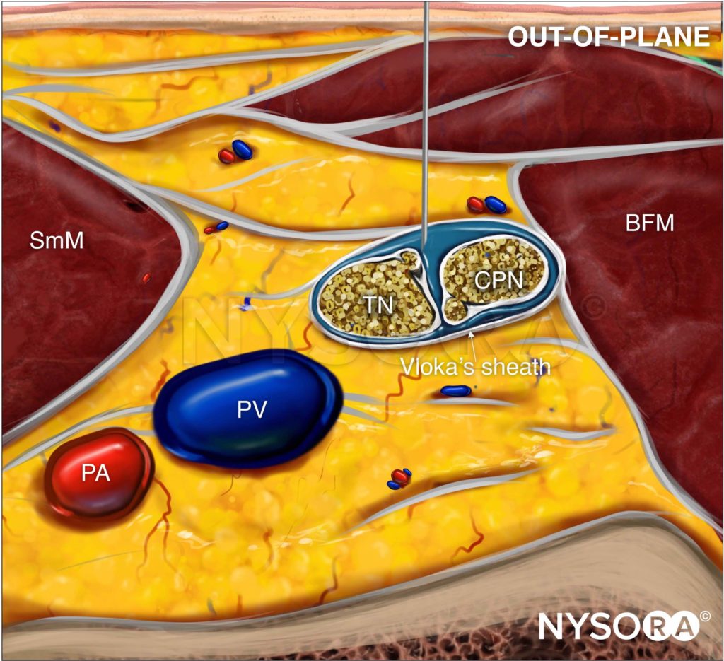 Ultrasound-Guided Popliteal Sciatic Block - NYSORA