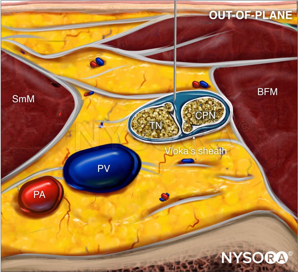 Ultrasound-Guided Popliteal Sciatic Nerve Block - NYSORA